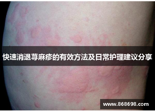 快速消退荨麻疹的有效方法及日常护理建议分享